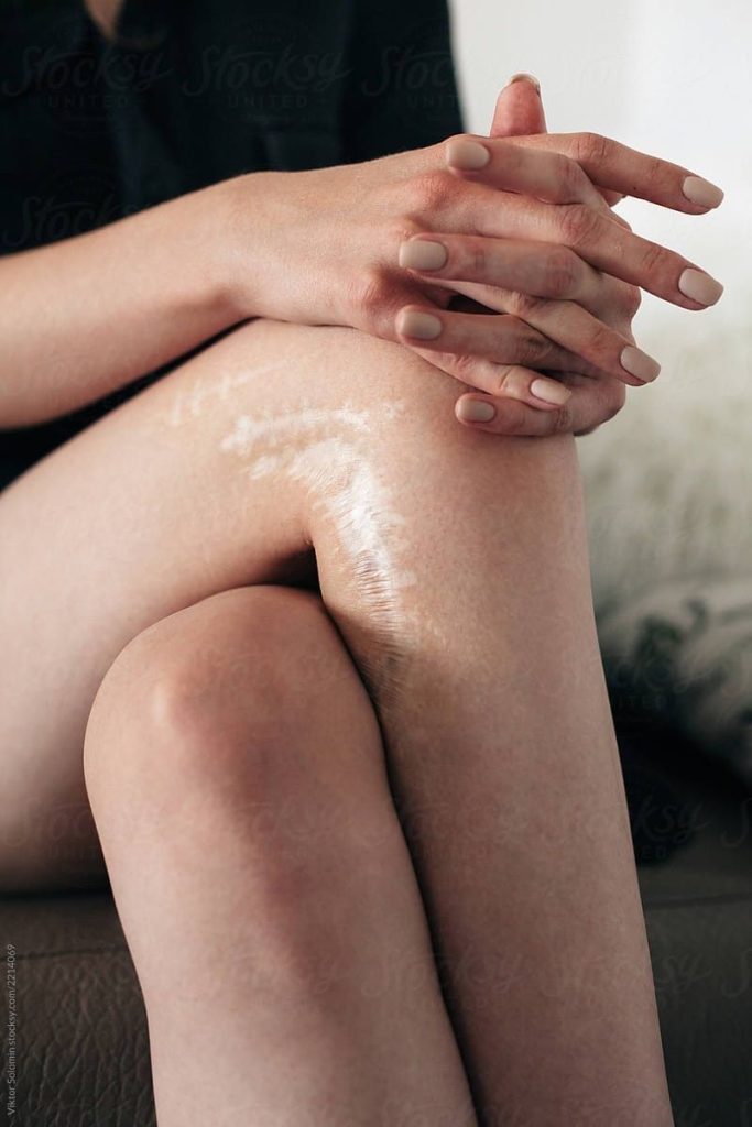 Mujer sentada con las manos entrelazadas y cicatrices visibles en la pierna